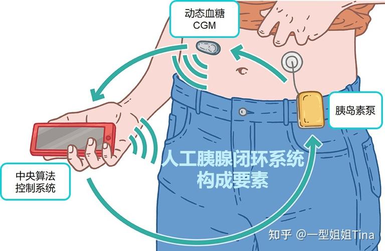 apsphp技巧_NEJM超越传统人工胰腺全天稳定血糖为糖尿病患者减负