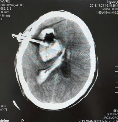 东莞php培训班技巧_硬通道 硬事理丨脑出血云教室第三期即将开讲啦