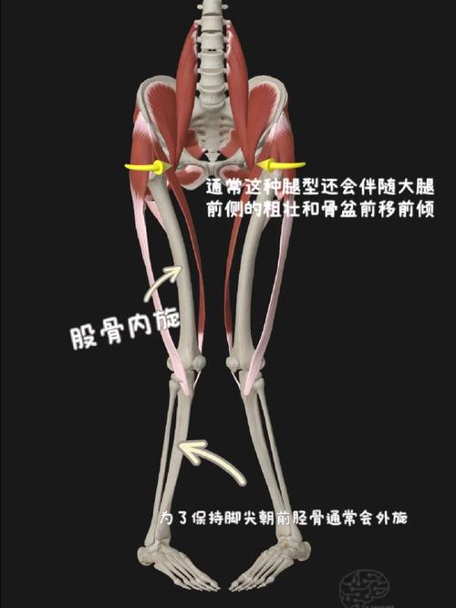 股骨php技巧_孩子走路扭捏腿不痛当心是先天性髋内翻