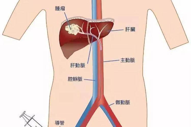 outflowphp技巧_肝切除术若何控制术中出血
