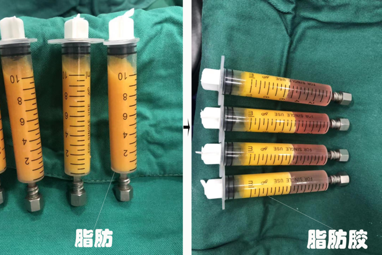 php脂肪胶技巧_颤抖吧肿瘤美国发明的特洛伊木马抗癌药来了