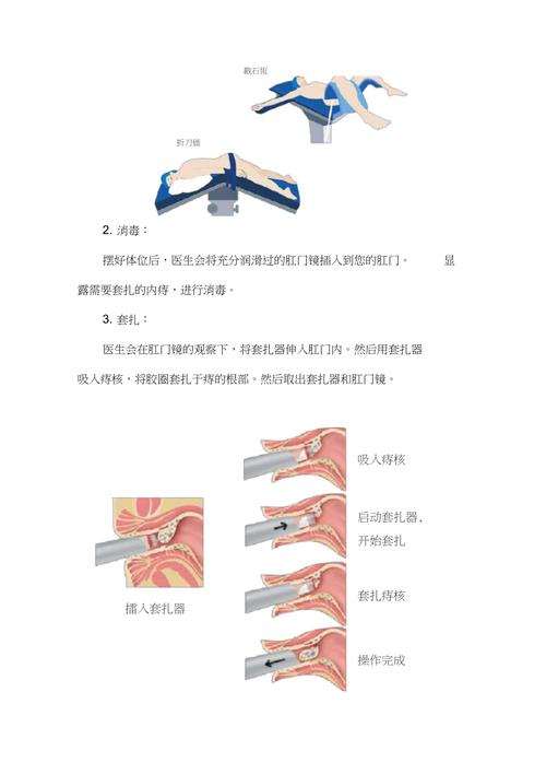 phptst痔疮技巧_治痔疮再添新疗法TST